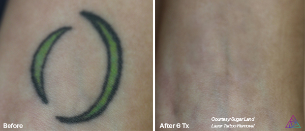 Before and after tattoo removal